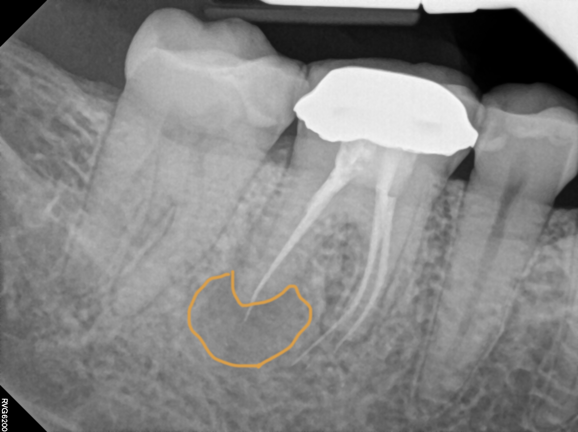 دندان عصب کشی شده در عکس رادیولوژی