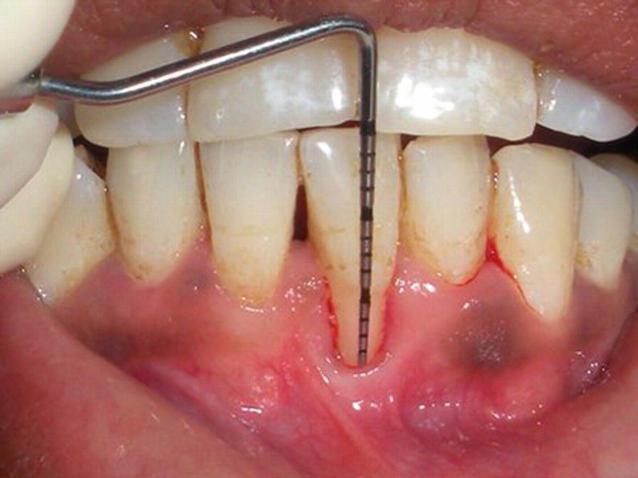 تحرک دندان