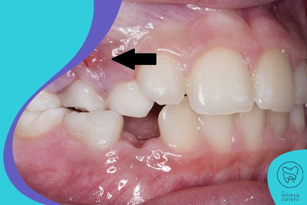 عکس آبسه دندان