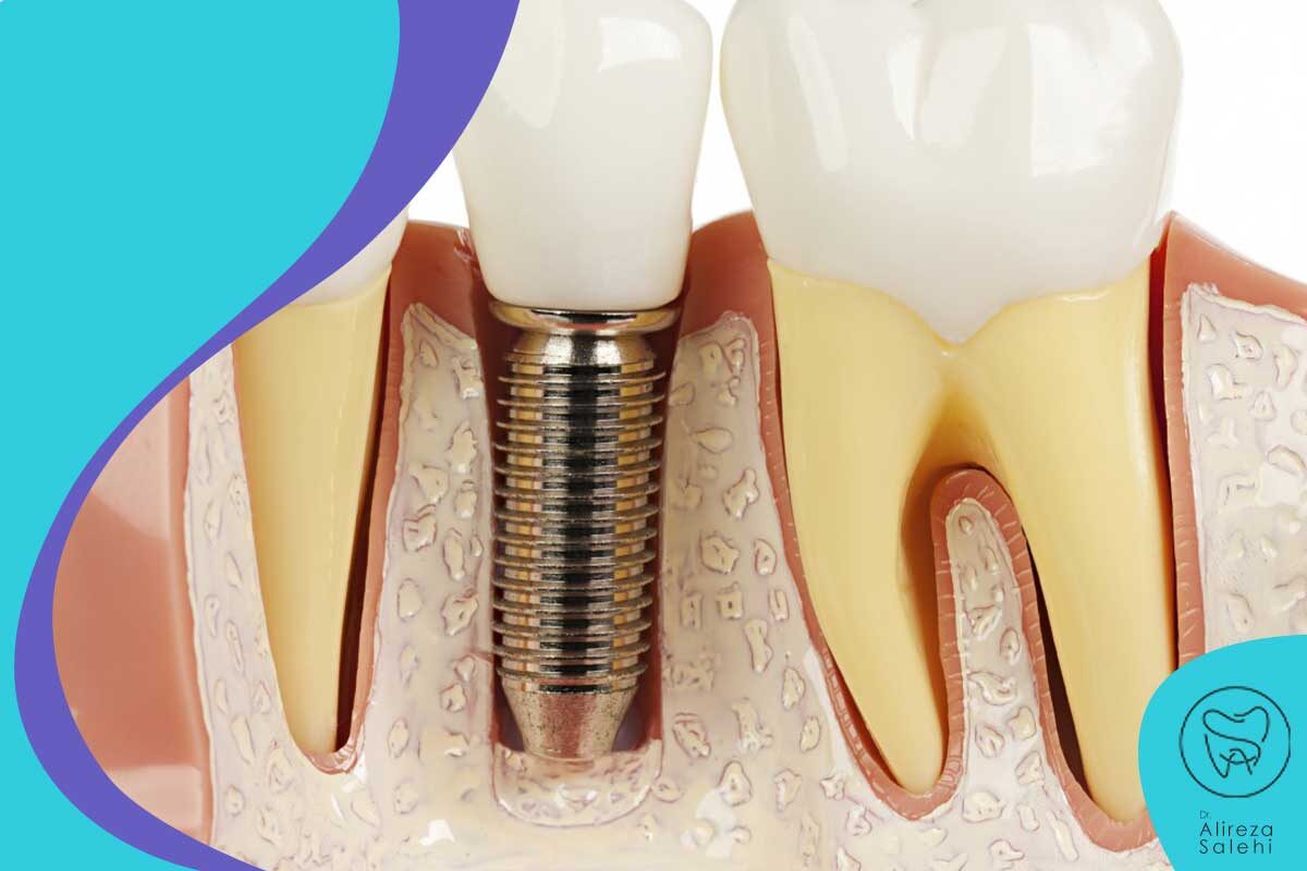 بهبودی ایمپلنت دندان