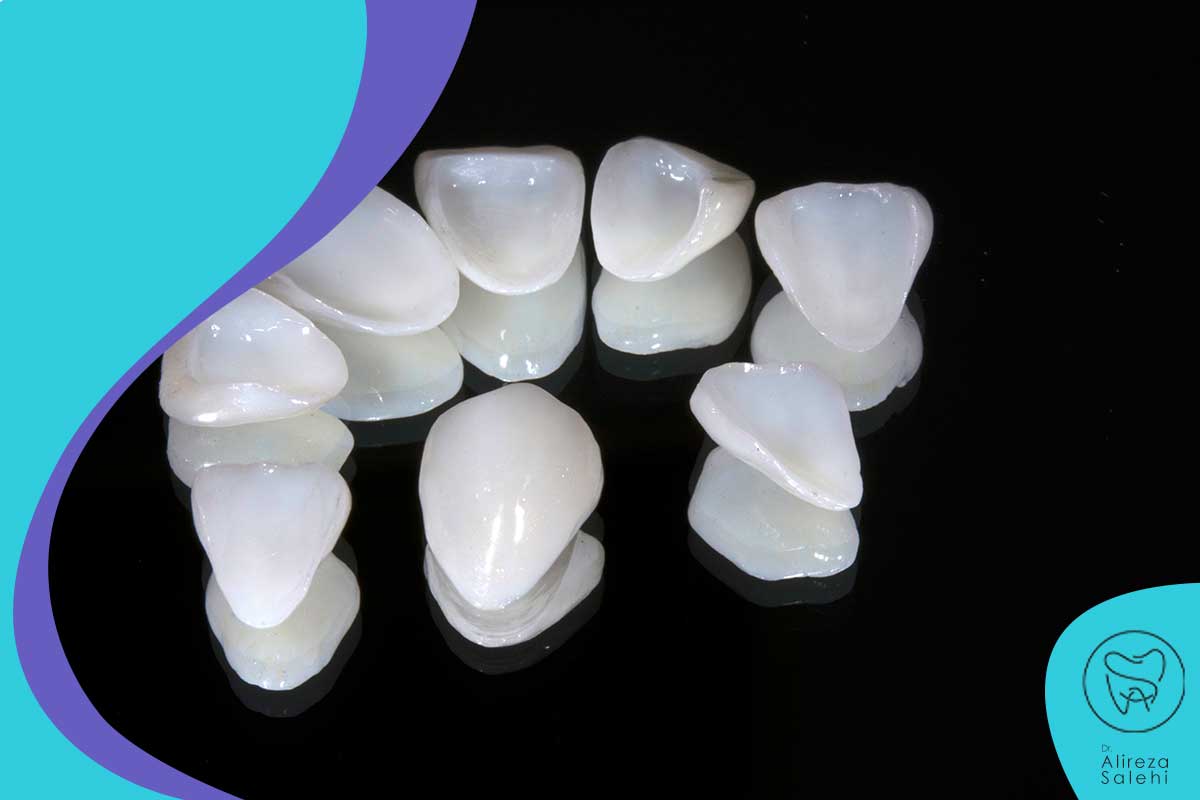 لمینت سرامیکی در زعفرانیه