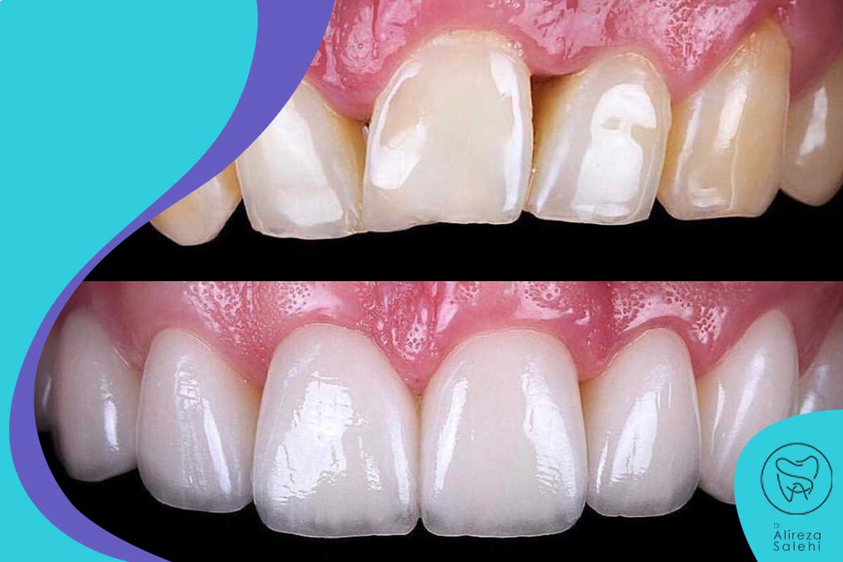 قبل و بعد لمینت سرامیکی در زعفرانیه