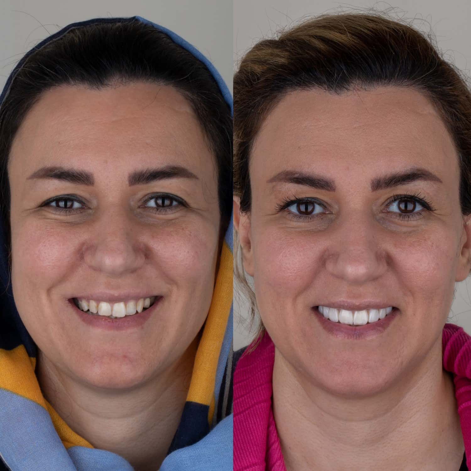 عکس قبل و بعد لمینت دندان
