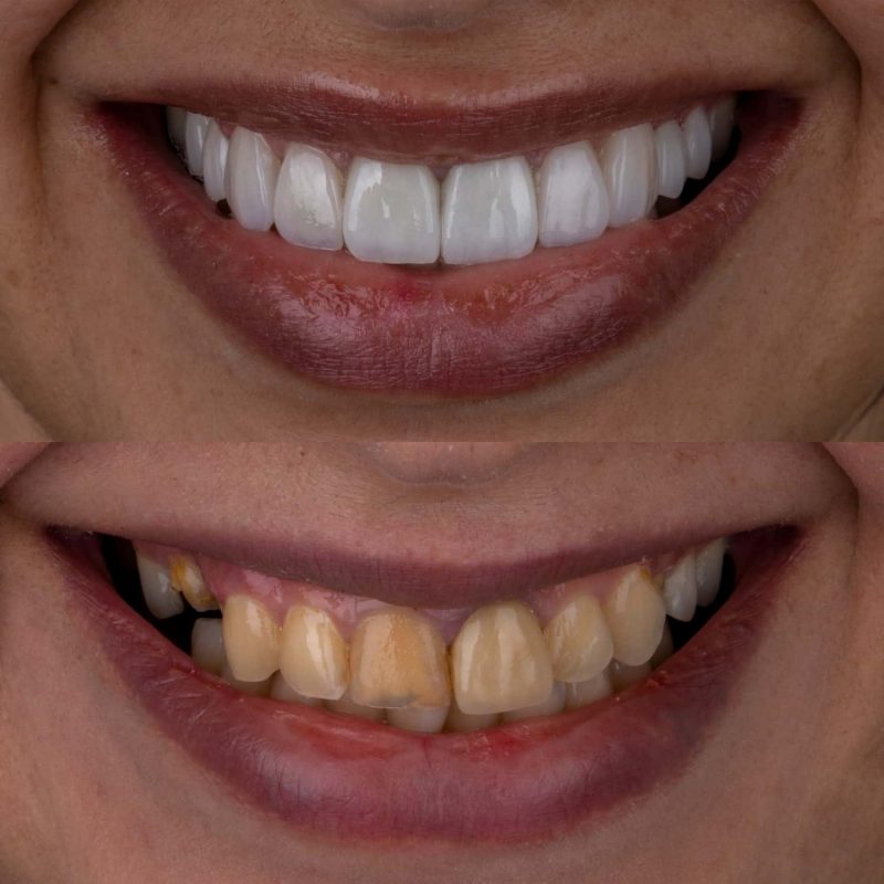 عکس قبل و بعد لمینت دندان در پالادیوم