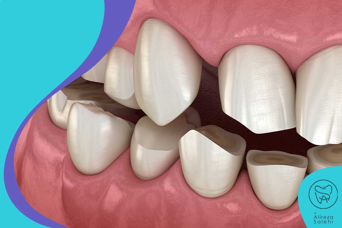 علل محیطی فرسایش سطح دندان چیست؟
