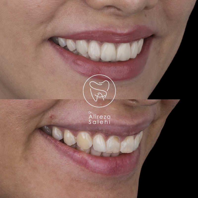 عکس قبل و بعد لمینت دندان در کلینیک دکتر صالحی