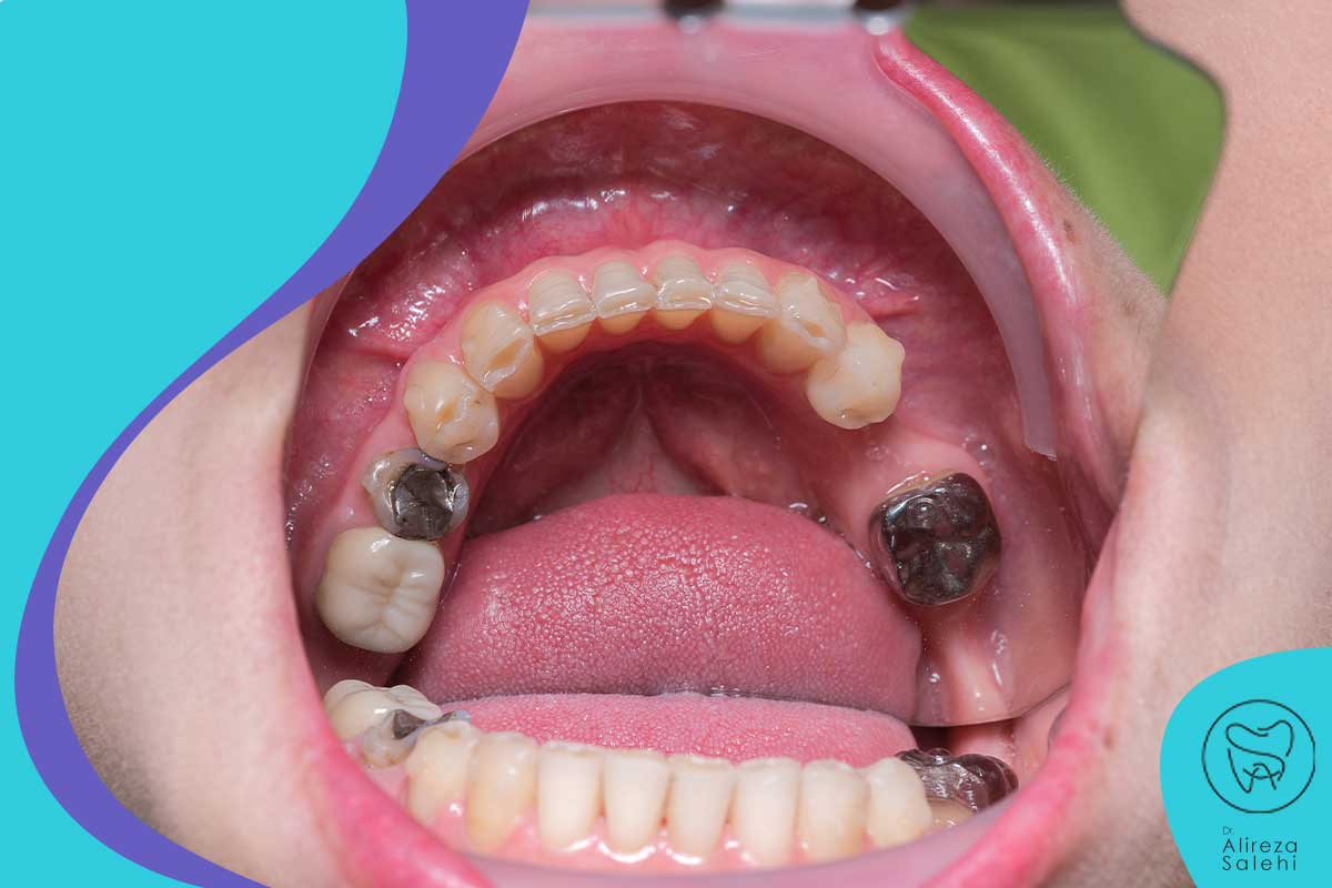 دندان های عفونی چه آسیب هایی به بدن وارد می کنند؟