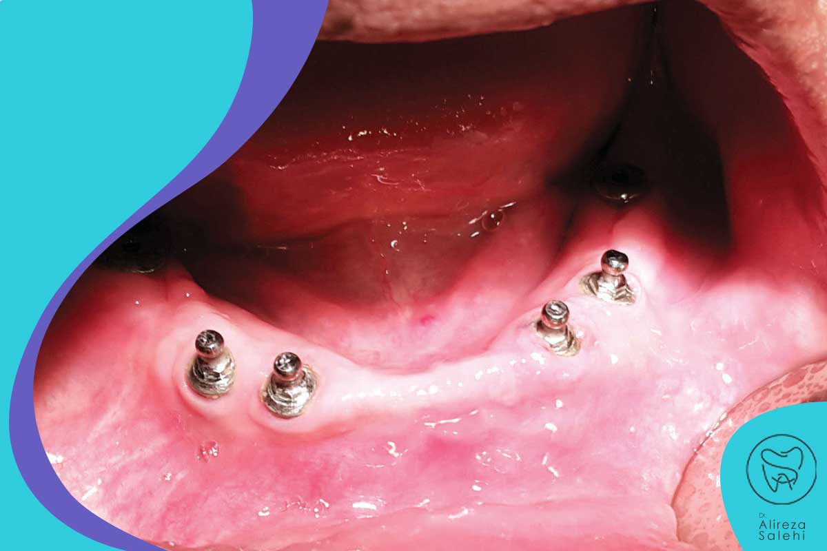 عوامل موثر بر طول عمر ایمپلنت های دندانی