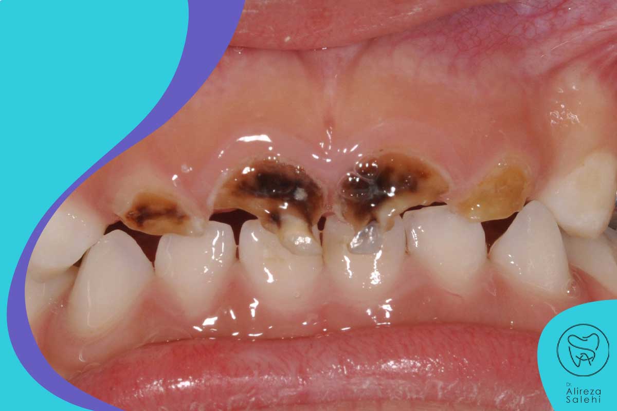عفونت شدید دندان چگونه تشخیص داده می شود؟