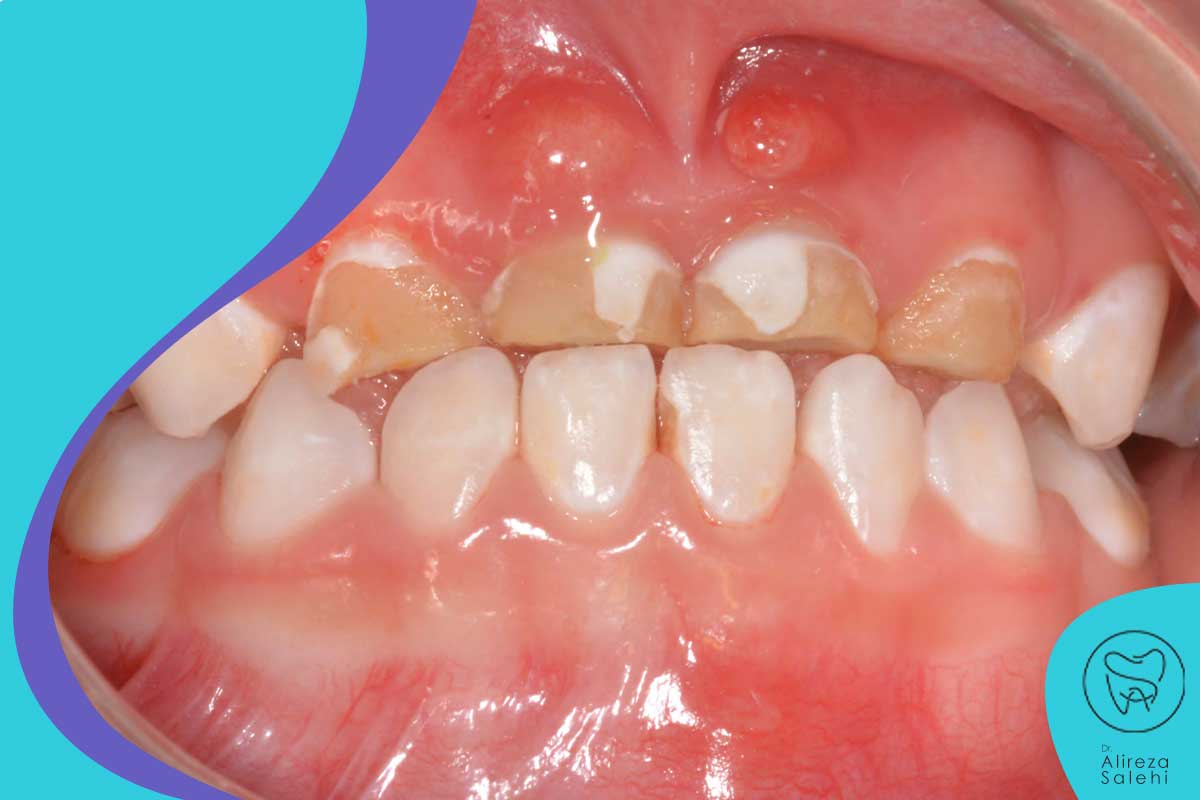 عفونت شدید دندان