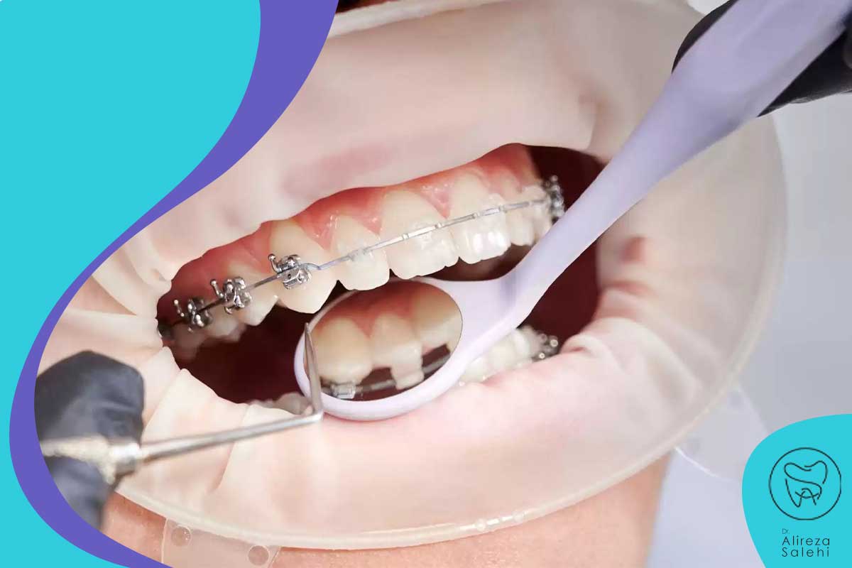 آیا هنگام استفاده از ارتودنسی می‌توانید دندان‌های خود را بلیچینگ کنید؟