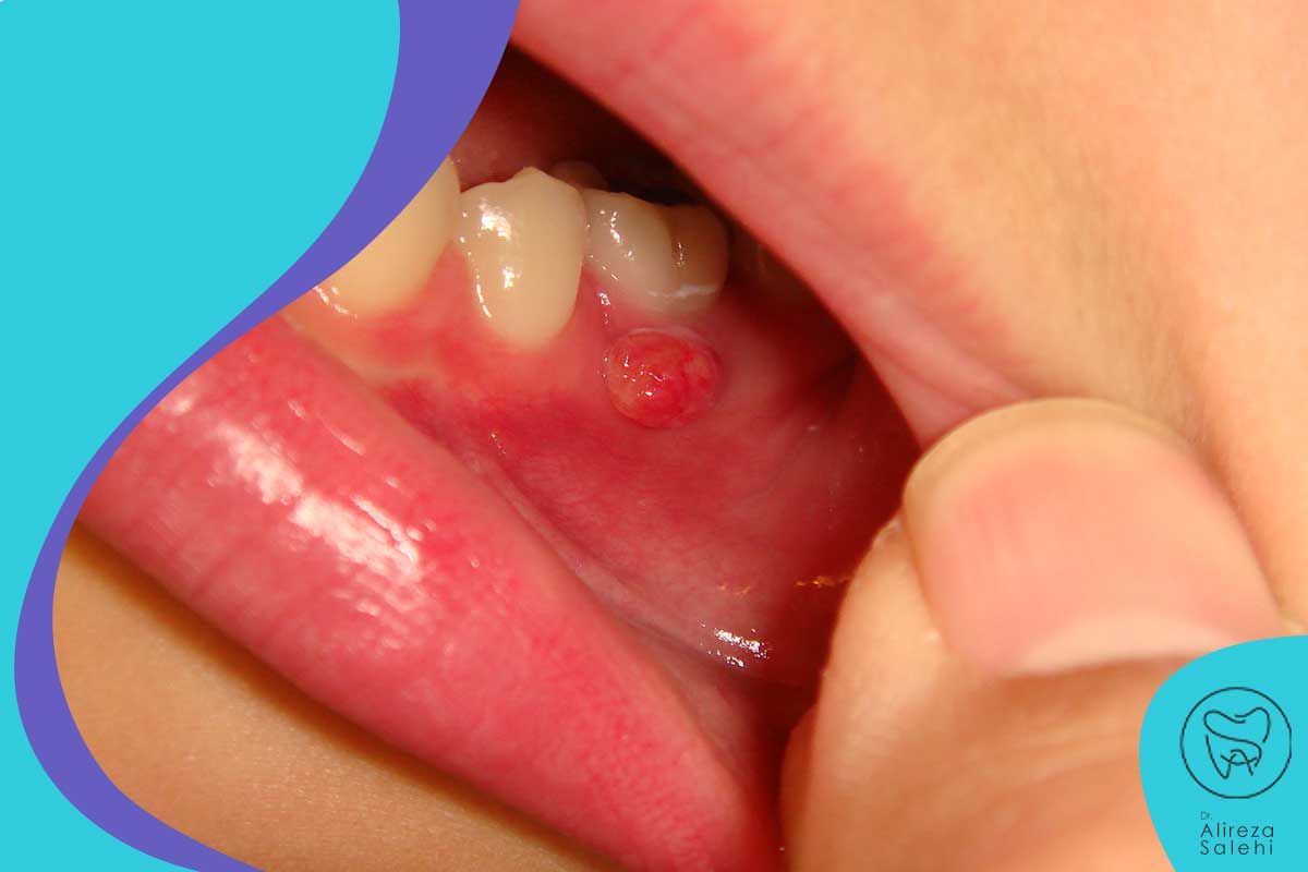 علت لکه خطوط سفید روی دندان ها و خط سفید زیر لثه چیست؟