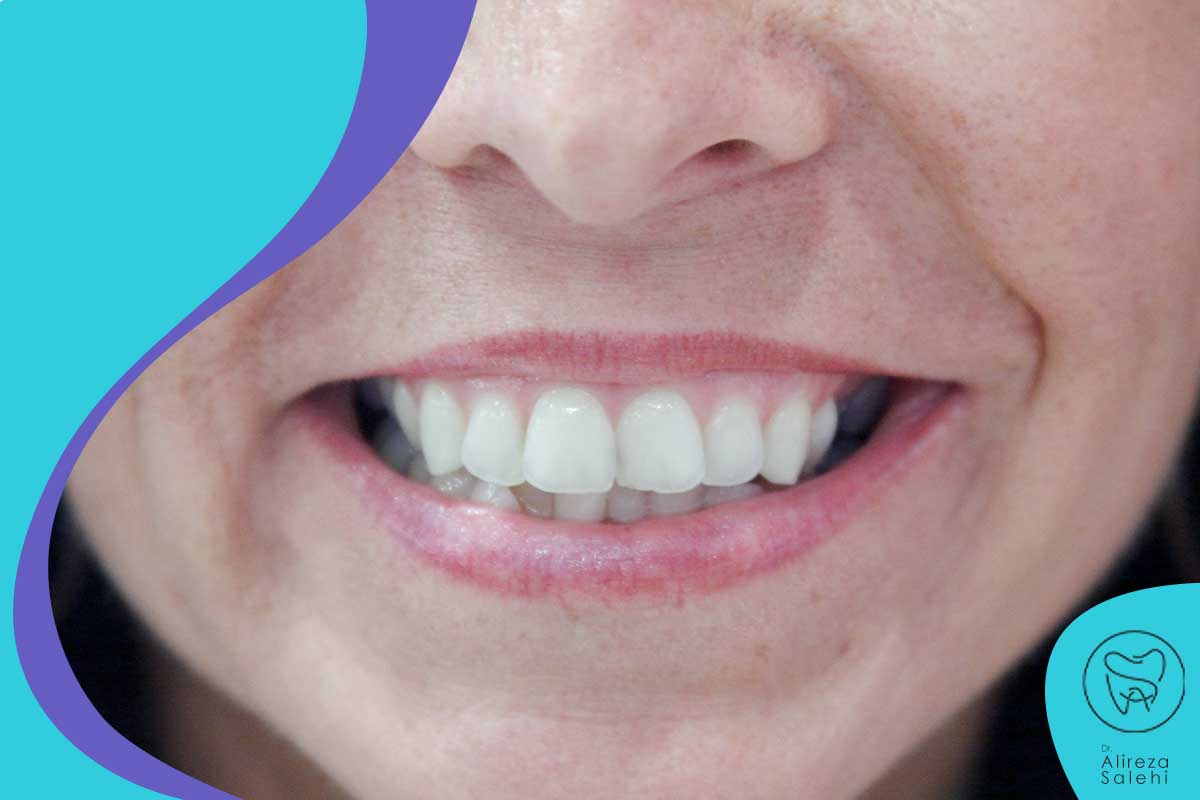 چرا ایمپلنت زعفرانیه دندان انجام می شود؟