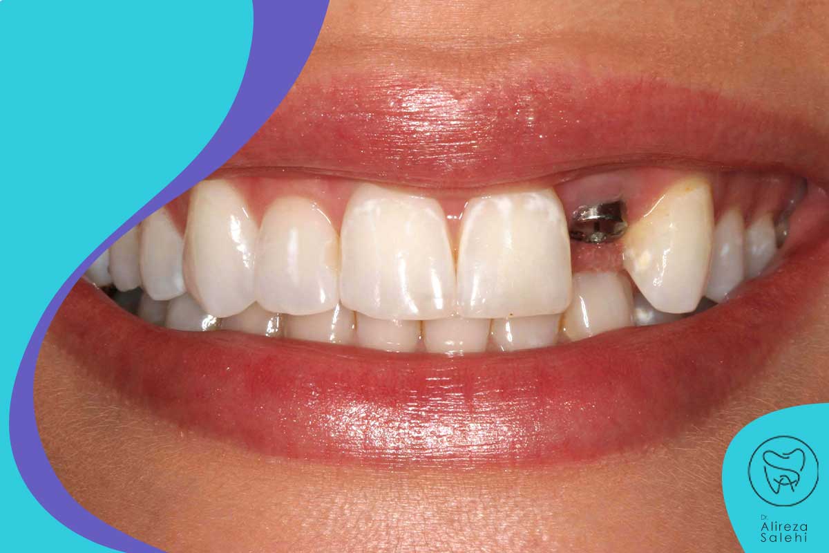 چند نوع ایمپلنت دندان وجود دارد؟