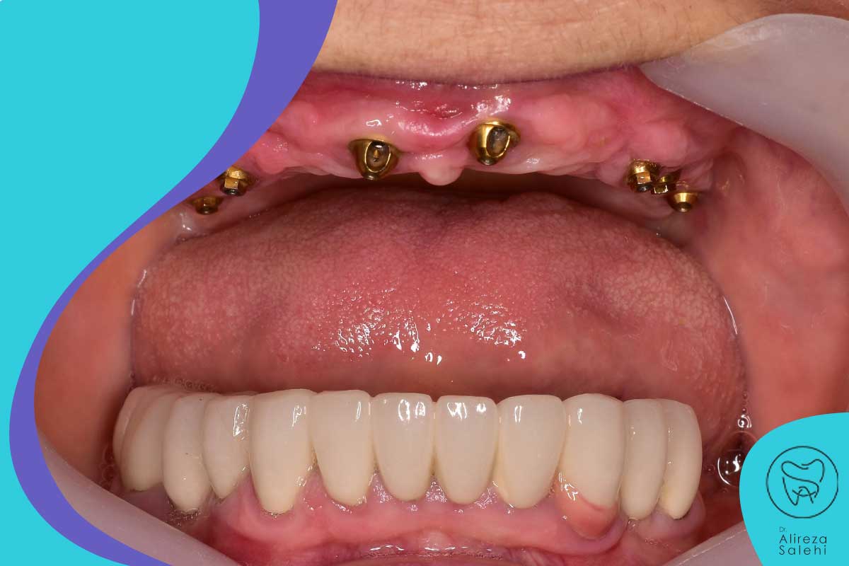انواع ایمپلنت دندان در تجریش