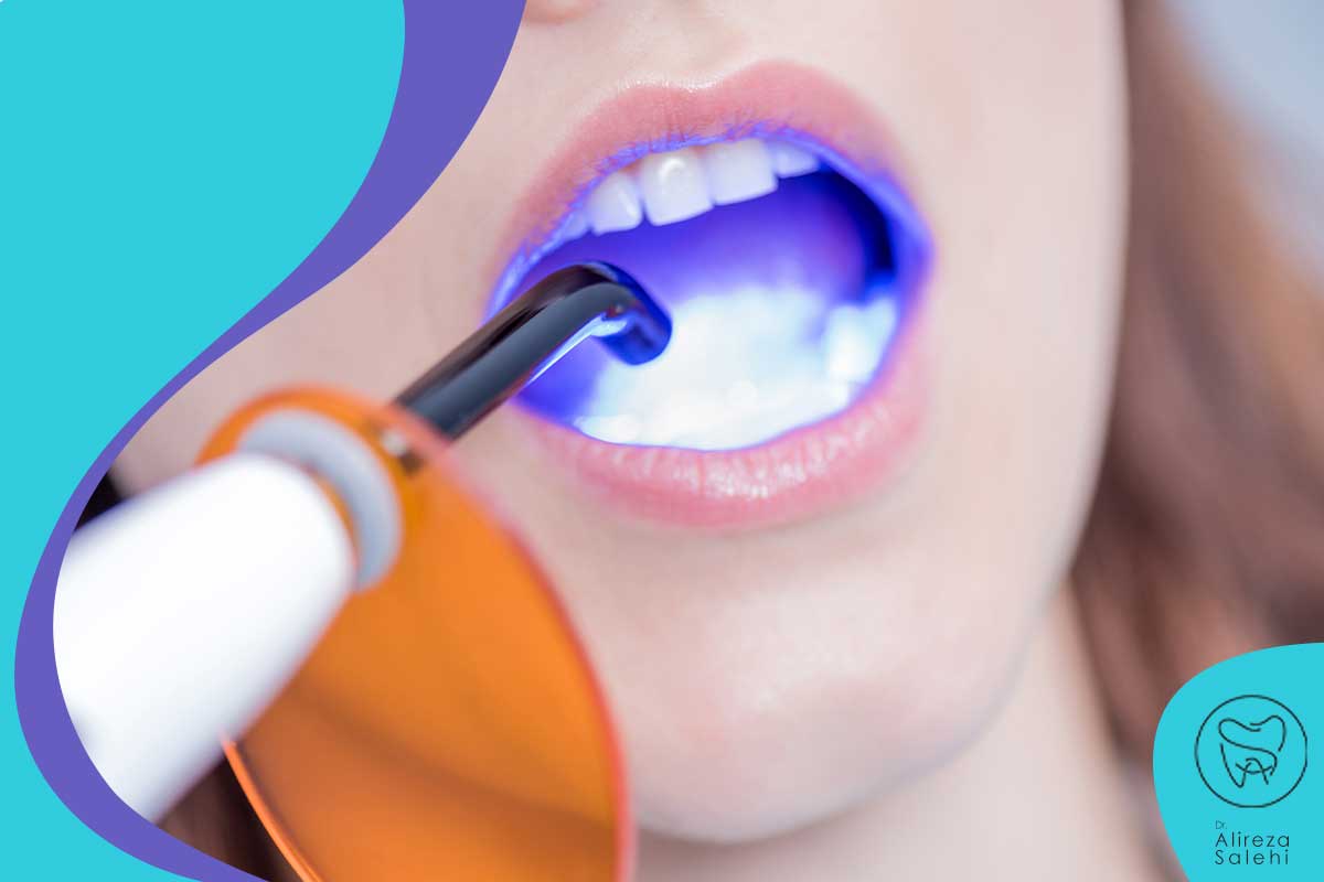 چگونه کامپوزیت دندان را سفید نگه داریم؟