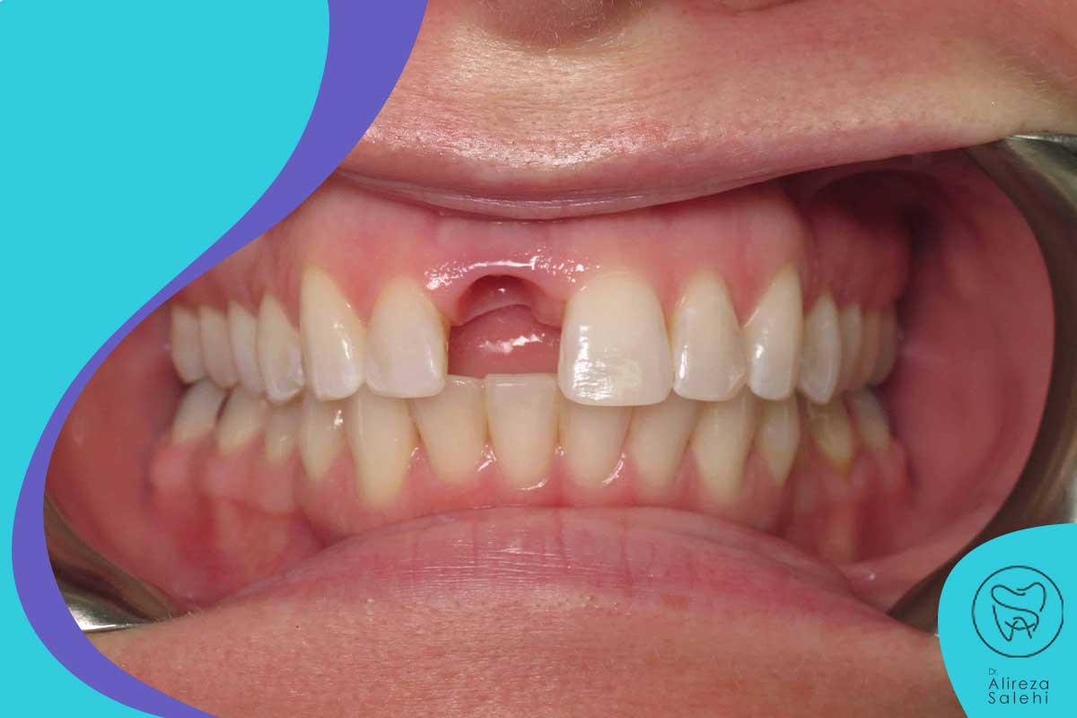ایمپلنت دندان در تجریش برای چه کسانی و در چه شرایطی اعمال می‌شود؟
