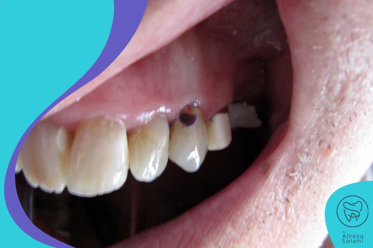 پوسیدگی دندان عامل اصلی برداشتن لمینت دندان