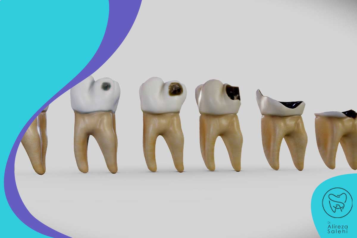 پوسیدگی دندان های دائمی