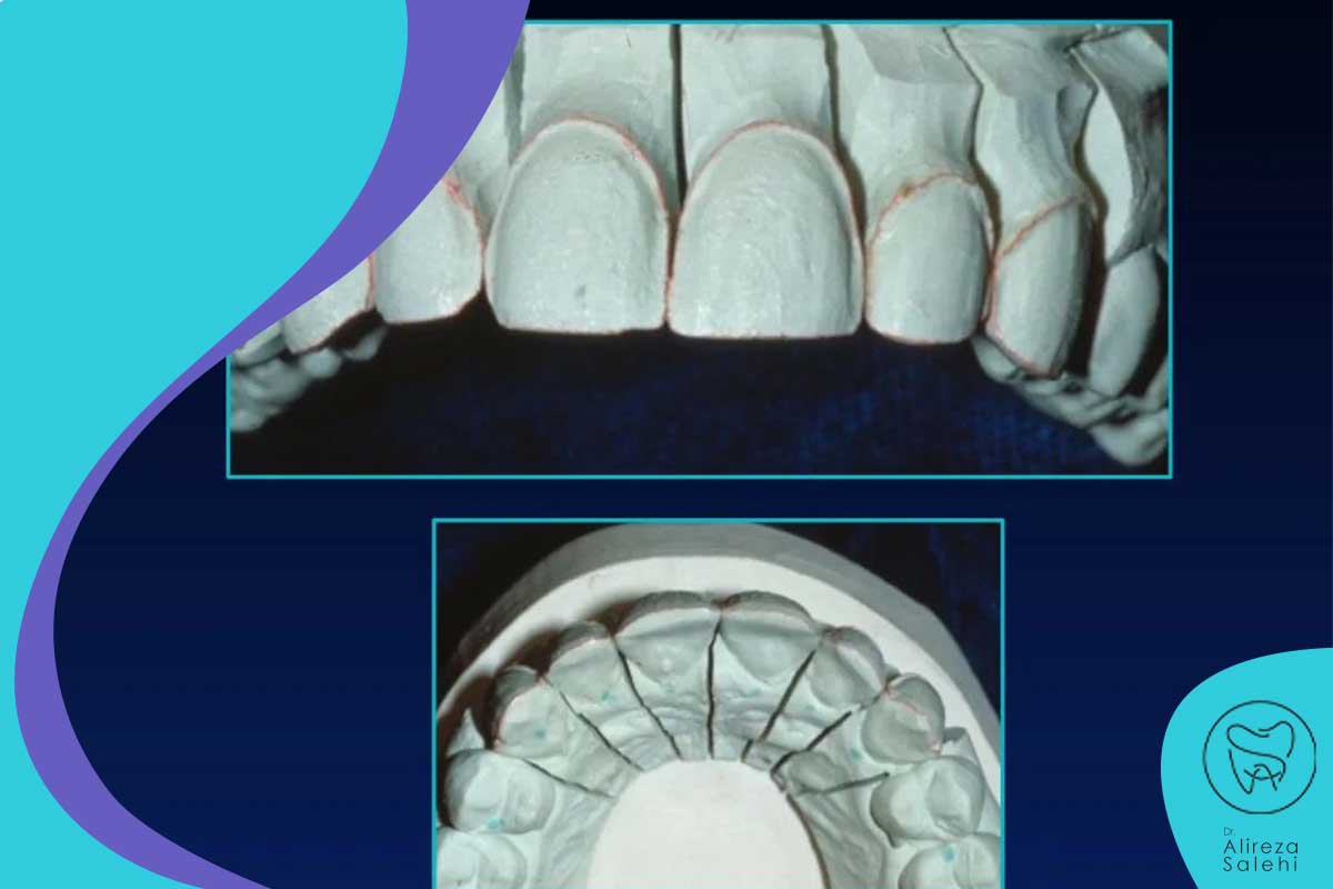 فناوری تصویربرداری دیجیتال تکنولوژی لمینت دندان