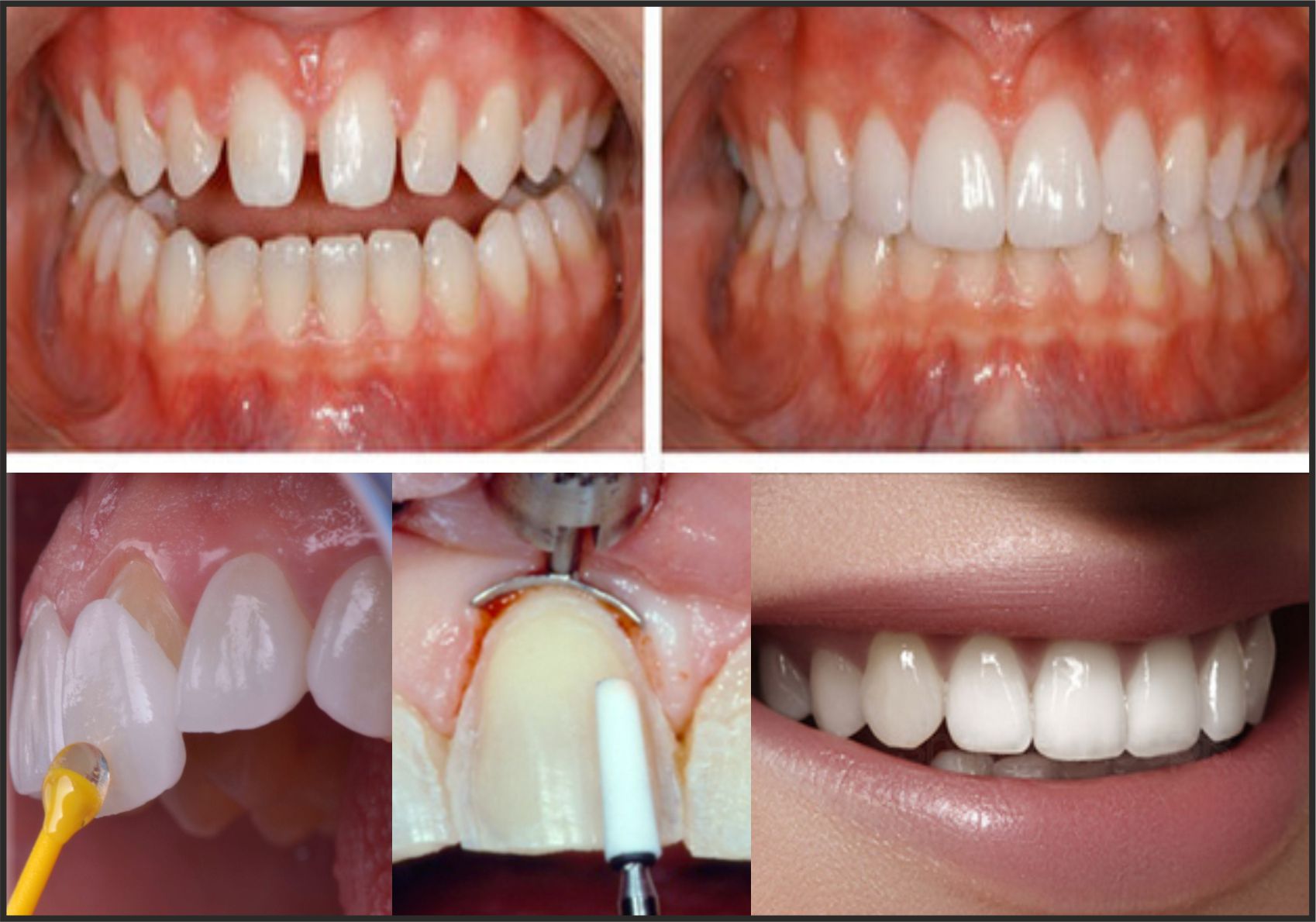 مرحله سوم از مراحل لمینت دندان: آماده سازی دندان‌ها