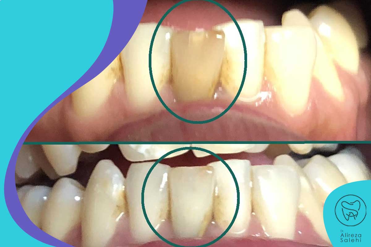 عوارض غیر معمول بلیچینگ دندان