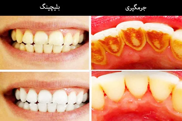 تفاوت بلیچینگ و جرم گیری دندان