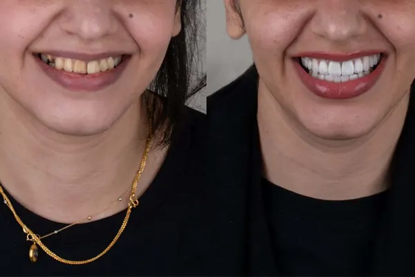 مزایای لمینت دندان برای مرتب و سفید کردن دندانهای جلو