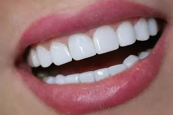 از کامپوزیت دندان چه بخوریم
