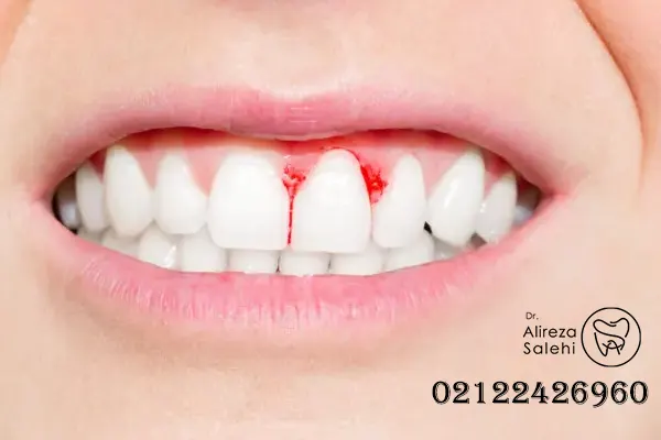 خونریزی لثه بعد از ایمپلنت دندان