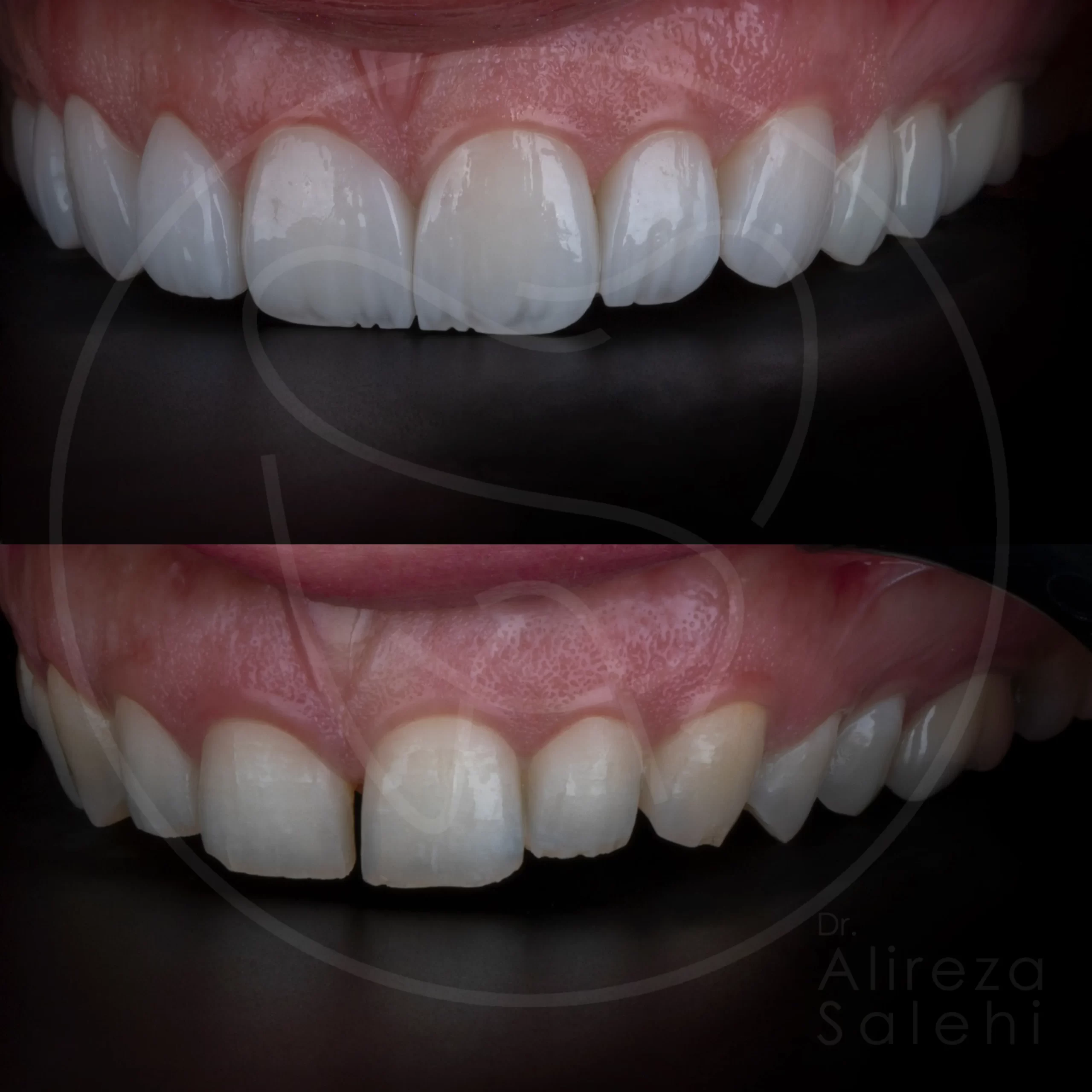 لمینت دندان در کلینیک دندانپزشکی دکتر علیرضا صالحی 29