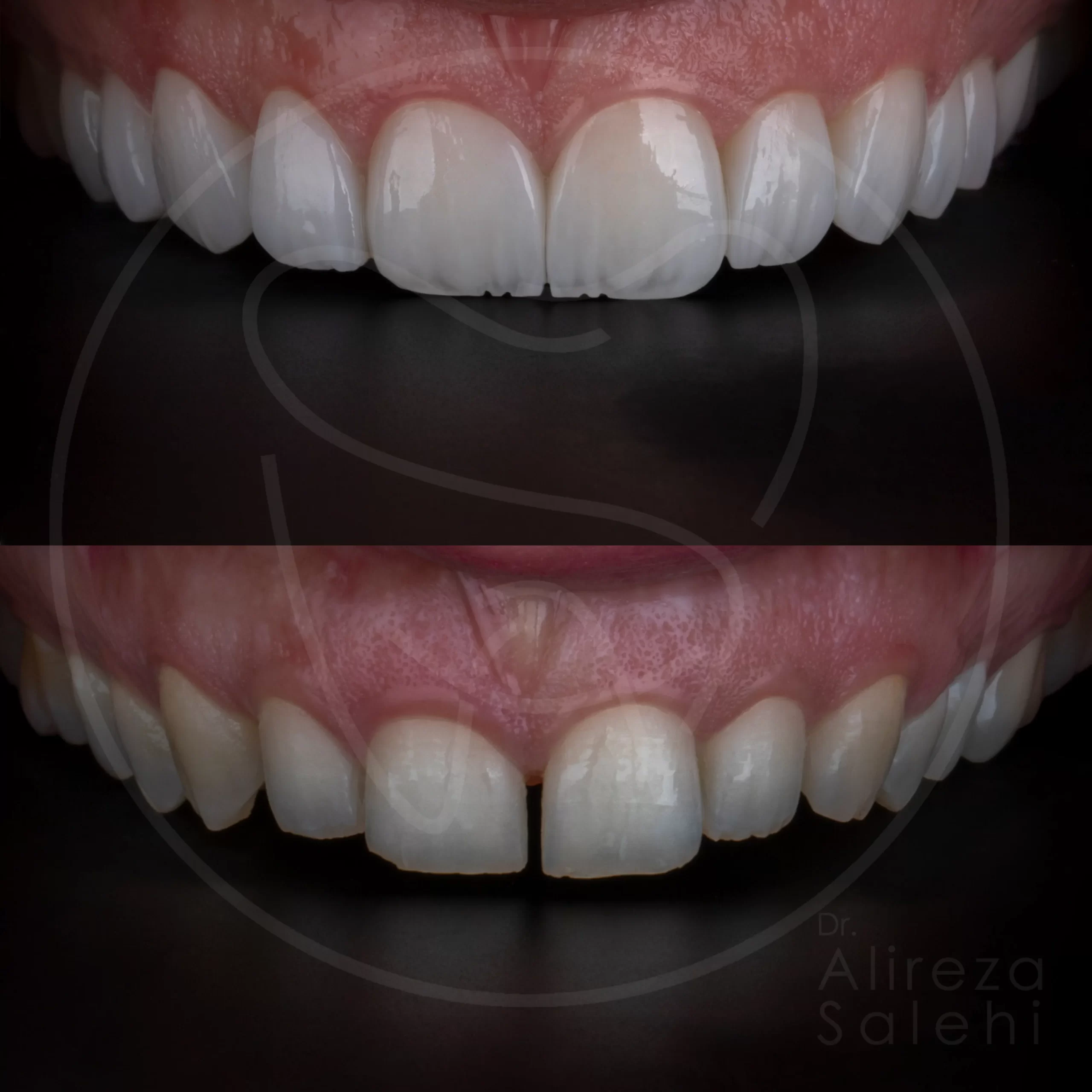 لمینت دندان در کلینیک دندانپزشکی دکتر علیرضا صالحی 28