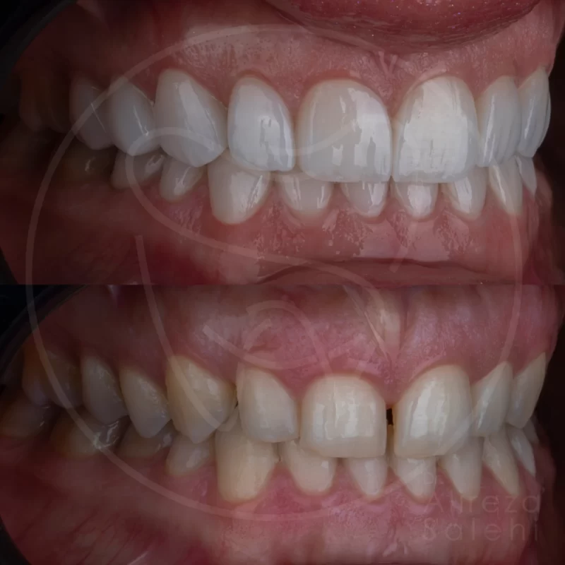 لمینت دندان در کلینیک دندانپزشکی دکتر علیرضا صالحی 24