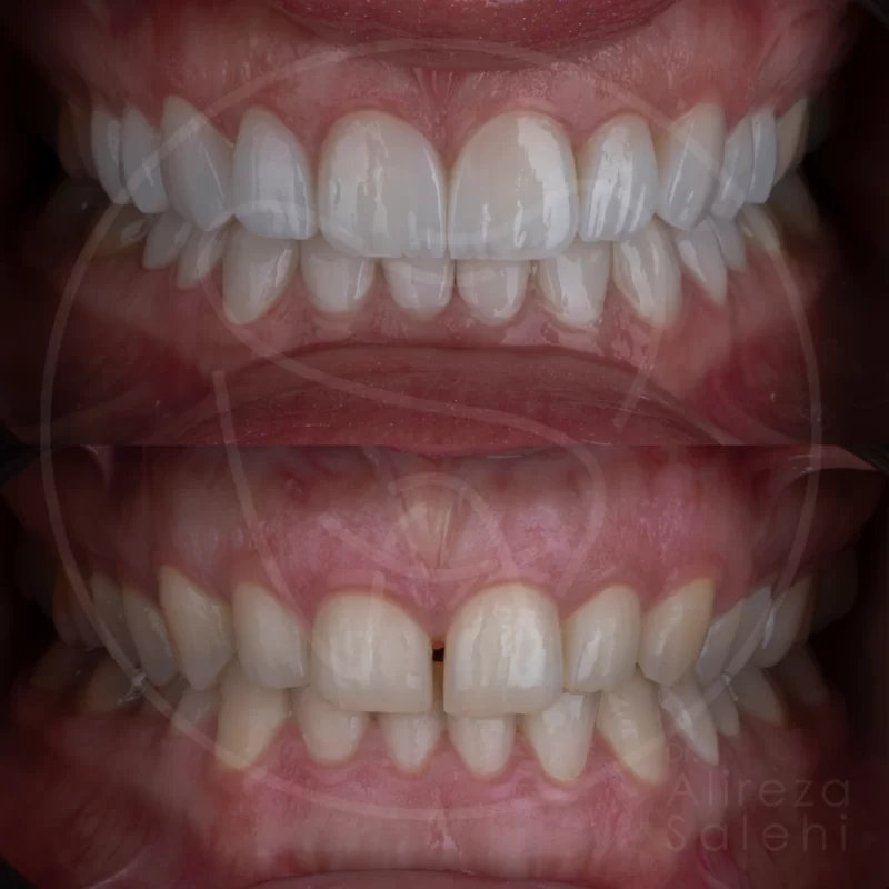لمینت دندان در کلینیک دندانپزشکی دکتر علیرضا صالحی 23