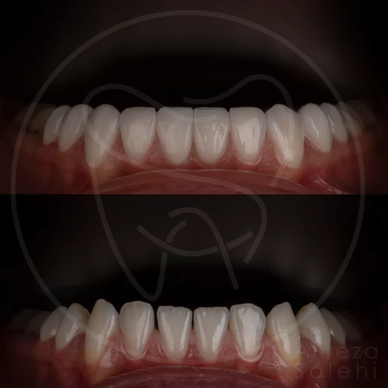 لمینت دندان در کلینیک دندانپزشکی دکتر علیرضا صالحی 20