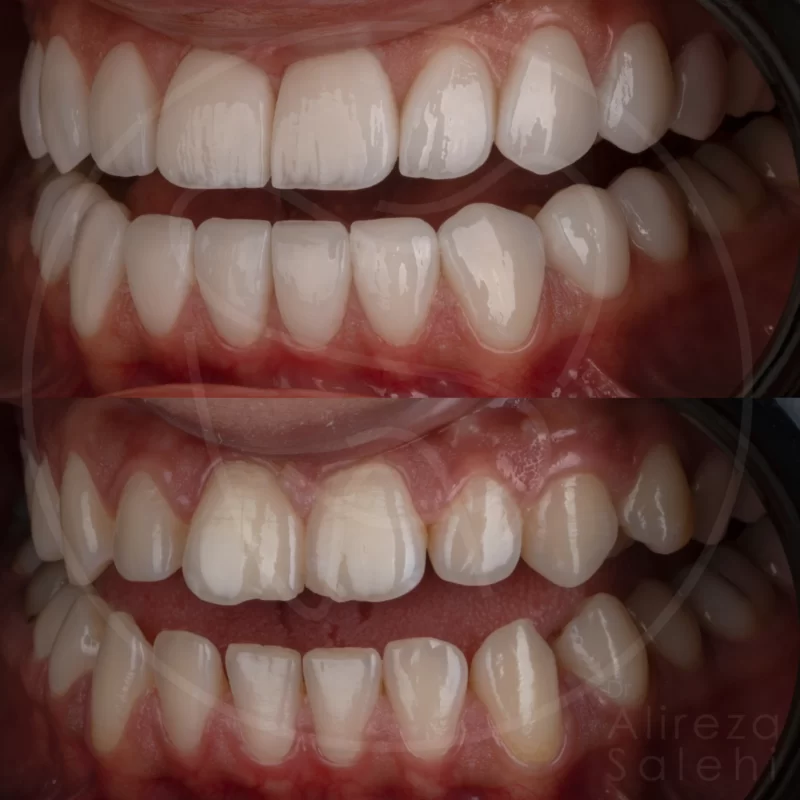 لمینت دندان در کلینیک دندانپزشکی دکتر علیرضا صالحی 16