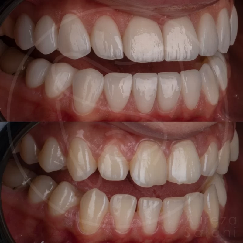 لمینت دندان در کلینیک دندانپزشکی دکتر علیرضا صالحی 15