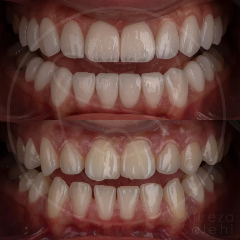 لمینت دندان در کلینیک دندانپزشکی دکتر علیرضا صالحی 14