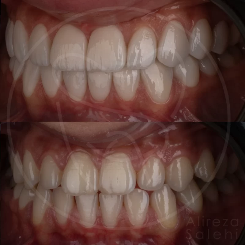 لمینت دندان در کلینیک دندانپزشکی دکتر علیرضا صالحی 13