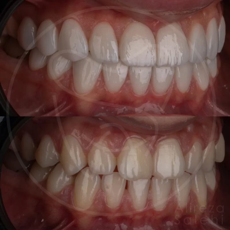 لمینت دندان در کلینیک دندانپزشکی دکتر علیرضا صالحی 12