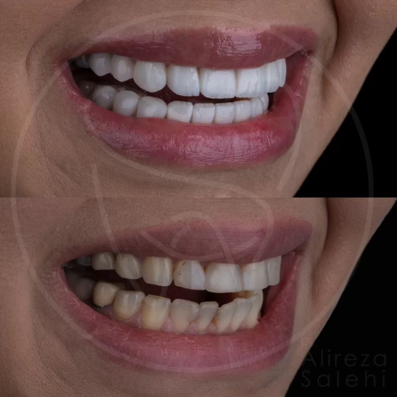 لمینت دندان در کلینیک دندانپزشکی دکتر علیرضا صالحی 5