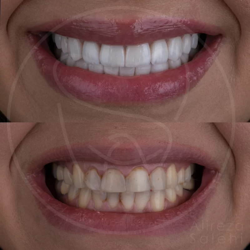 لمینت دندان در کلینیک دندانپزشکی دکتر علیرضا صالحی 4